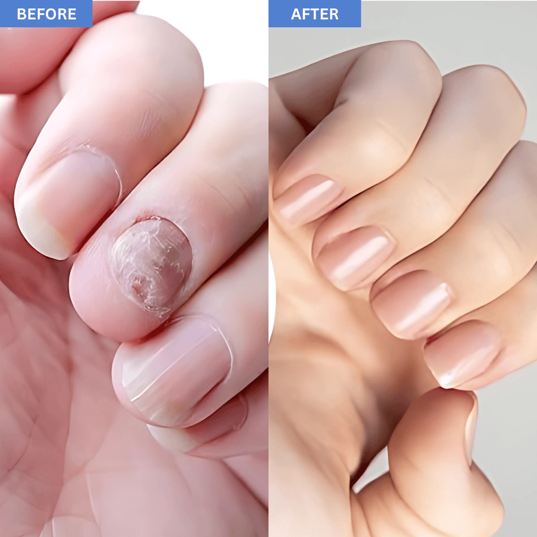 RTL™ Portable Light Therapy Device for Fungal Nail Repair